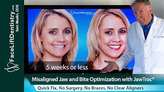 Misaligned Jaw Alignment and Bite Correction Without Surgery Braces or Aligners [upl. by Nyltiak]