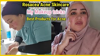 How i Treat my Rosacea acne skin👍No makeup loks Acne issues [upl. by Haronid201]