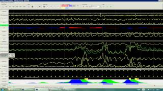 E Learning Guide dutilisation  Lecture des Polygraphies Ventilatoires [upl. by Ahsikyw678]