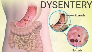 What is Dysentery Bacillary dysentery Amoebic dysentery DysenterysymptomsDiagnosis Treatment [upl. by Nibla793]