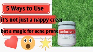 I Tried Sudo Cream For Acne [upl. by Fira]