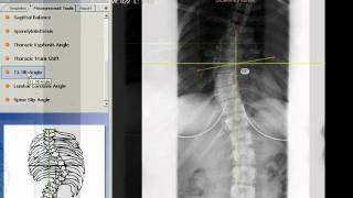 TraumaCad  T1 Tilt Angle [upl. by Yttak]