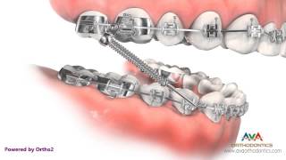 Orthodontic Treatment for Overjet Overbite  Forsus Appliance [upl. by Korella]