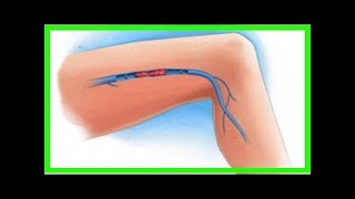 Symptômes d’une thrombose veineuse dans les jambes [upl. by Adnoryt]