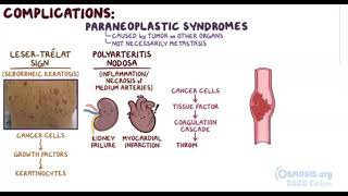 Gastric Cancer  Osmosis [upl. by Armanda]