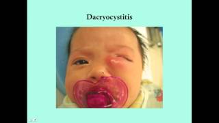 Dacryocystitis  CRASH Medical Review Series [upl. by Akissej]