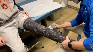 BROKEN TIBIAL EMINENCE  FULL LEG CAST REMOVAL AND NEW BRACE [upl. by Adnohs950]