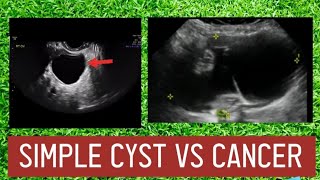 7differences between ovarian cyst amp cancer in urdu  ovary cyst can turn into cancer  ovarian tumor [upl. by Aiket]