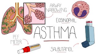 Asthma Explained Including Pathophysiology [upl. by Gran752]