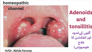 ADENOIDS AND TONSILLITIS Treatment in homeopathy [upl. by Ettennaj]