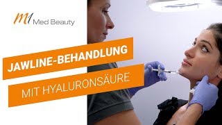 FaceContouring mit Hyaluron [upl. by Chien38]