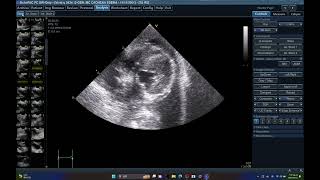 56334 TFAST LUNG ULTRASOUND PULMONARY EDEMA EFFUSION PH75 ECHOPAC ANALYSIS [upl. by Mapes]