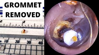 Shah Grommet Extracted From Ear Canal And Deep Retraction Pocket Seen Pre Cholesteatoma [upl. by Ludlew211]