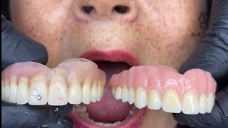 PRÓTESIS DENTAL FLEXIBLE O ACRILICA  🤔🤔 viral odontologia fypシ [upl. by Christiansen158]