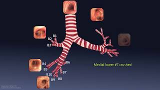 Mastering Bronchoscopy for Thoracic Surgery Chapter 1 [upl. by Norling]