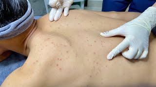 ACNE TREATMENT VU QUYNH MI Blackheads On Boy Back 2024 [upl. by Anavi]