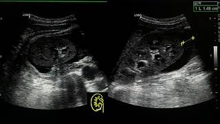 acute pyelonephritis ultrasound case [upl. by Anilrahc]