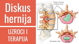 Diskus hernija  LIJEČENJE DIJAGNOSTIKA SIMPTOMI I UZROCI  dr Gordana Ljoljić Dolić fizijatar [upl. by Anwadal914]