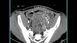 Abdomen Small Bowel EnteritisSeries of coronal sagittal volume rendered and MIP images4 of 6 [upl. by Dnalkrik]