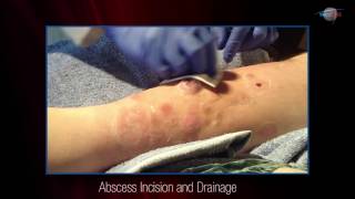 WCW Abscess Incision and Drainage [upl. by Merritt678]