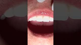 Cementing anterior zirconia crowns dentist teeth tooth dentista dentistteeth teethsmile [upl. by Pendleton]