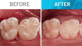 Step by step ONE Shade restoration with Venus Pearl ONE by Dr Zorzin EN [upl. by Idnahc711]