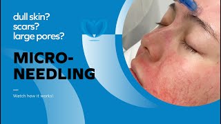 How to Treat Large Pores Uneven Skin Texture Pigmentation and Wrinkles  Microneedling Treatment [upl. by Atinreb]