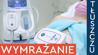 Jak działa kriolipoliza CoolShaping Pokazujemy zabieg wymrażania tłuszczu na brzuchu [upl. by Perdita809]