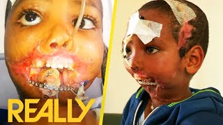 Ethiopian Boy Gets Miraculous Jaw Reconstruction Surgery After Hyena Attack  Body Bizarre [upl. by Leidgam]