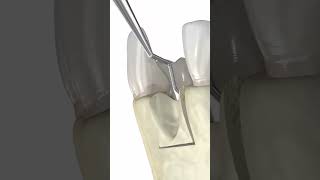 Dental bone graft 3d animation medicalanimation dentalprocedure [upl. by Cheshire]