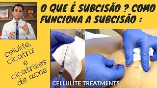 O que é subcisão  Como funciona a Subcisão para celulite cicatriz e cicatrizes de acne [upl. by Manda148]