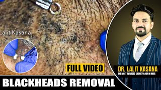 Blackheads Rmoval by Dr Lalit Kasanas [upl. by Amhser224]