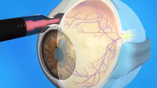 Glaucoma Cyclophotocoagulation CPC [upl. by Whitehurst835]