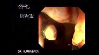 Video Hemorrhoids rubber band ligation 3 [upl. by Aillij217]