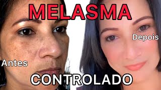 MELASMA CONTROLADO  VEJA O ANTES E DDPOIS  Silvania Sends [upl. by Naujat]