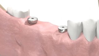 SIC invent Dental Implant  Prosthetic Animation BridgeWork Open Tray Technique [upl. by Holle483]