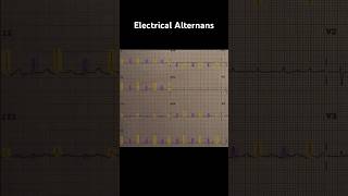 Electrical Alternans ECG Example 2 [upl. by Inalaeham961]