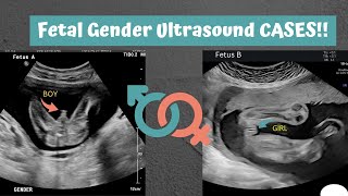 Its baby boys Day  Gender Compilations  various weeks Ultrasound cases [upl. by Moor]