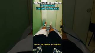 ROTURA DE TENDÓN 300 VOLTIOS shortsvideo shorts peru tendonitis viral fypシ fypp foryou fyp [upl. by Descombes]