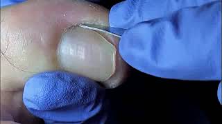 DIY Ingrown Toenail Removal  How to Safely Cut Ingrown Toenails at Home [upl. by Ayor]