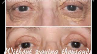 Xanthelasma removal at home without scarring the most time saving and cost effective solution [upl. by Nitram767]