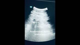 Abdominal aortic aneurism with intraluminal hematoma echocardiography ultrasound cardiacimaging [upl. by Lucilla358]