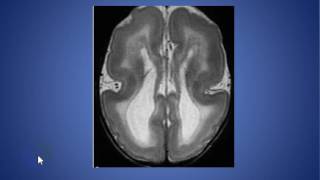 radiolgy cases lissencephaly [upl. by Sadiras]