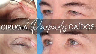 Cirugía de Párpados Caídos 👁️ BLEFAROPLASTIA de Párpado Superior❤️ Dra Lizbeth Zuñiga [upl. by Marje]