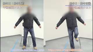 Case8 ：40代男性 小脳出血後1年半 構音障害･平衡感覚不全･歩行障害 幹細胞投与当日の記録 BTR ArtsGinzaClinic StemCell therapy Case8 [upl. by Hong]