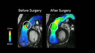 PrePostoperative visualization of blood flow from 4D Flow MRI [upl. by Holton]