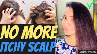 DIY  Extreme DRY amp ITCHY SCALP Treatment at Home  Magical Remedy For LICE SCALP ACNE amp DANDRUFF [upl. by Nyrrat]