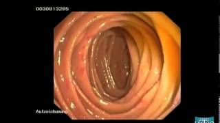 Hereditary Hemorrhagic Telangiectasia OslerWeberRendu Disease [upl. by Rheingold]