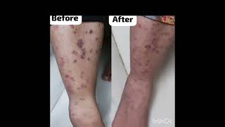 STOP SKIN PROBLEMS WITH HOMOEOPATHY [upl. by Burch375]