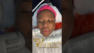 Facial remove dead skin cells and promote cell turnover spa facial chemicalpeels acnescars acne [upl. by Srednas]